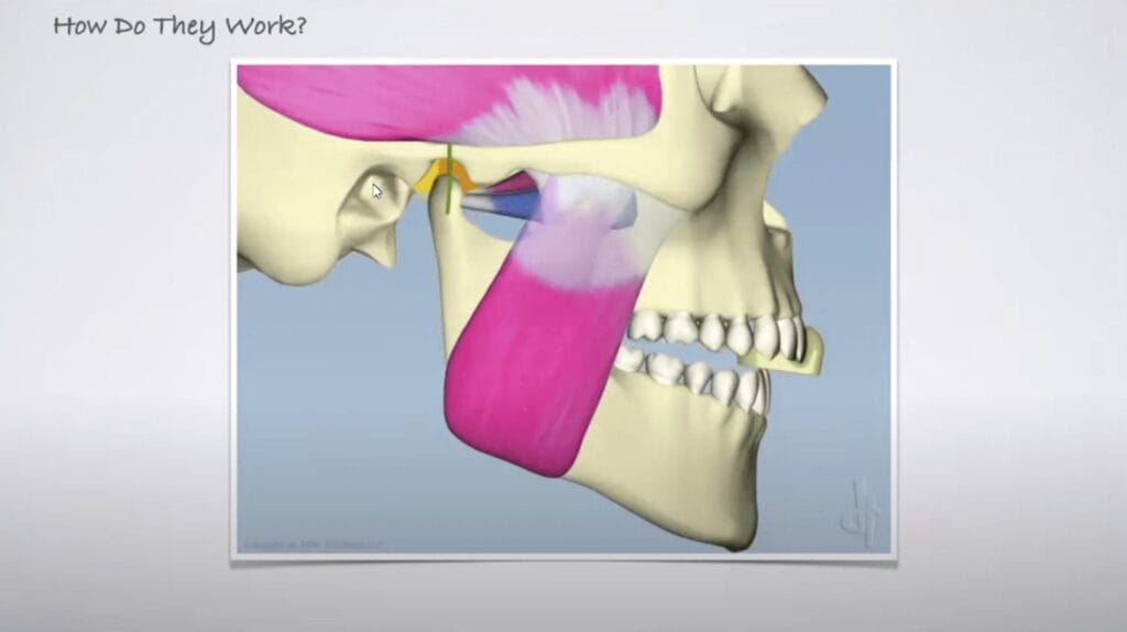 Image of TMJ for Dawson Academy webinar titled TMJ 101